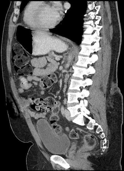 File:Closed loop obstruction - internal hernia into nephrectomy bed (Radiopaedia 59867-67320 C 38).jpg