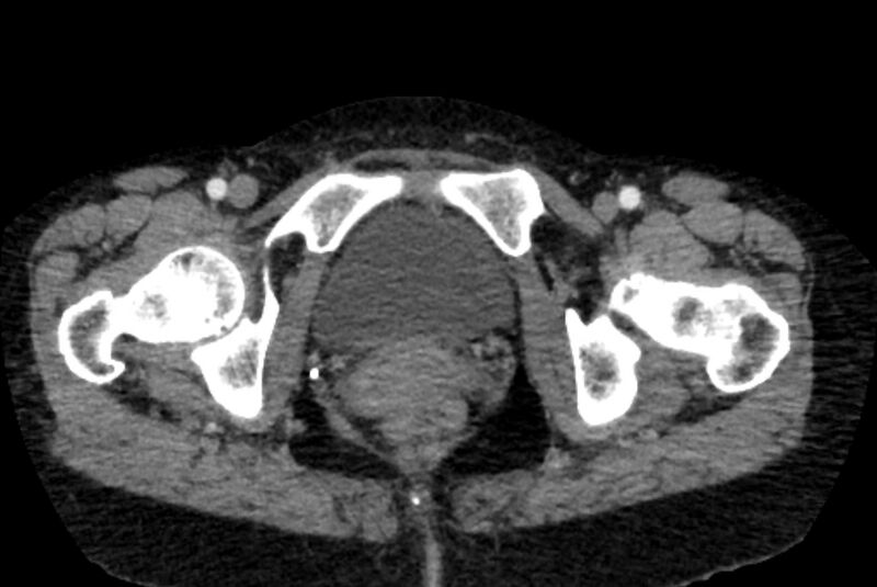 File:Closed loop small bowel obstruction (Radiopaedia 71211-81508 A 170).jpg