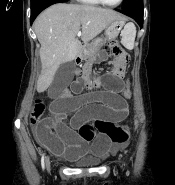 File:Closed loop small bowel obstruction (Radiopaedia 71211-81508 B 25).jpg