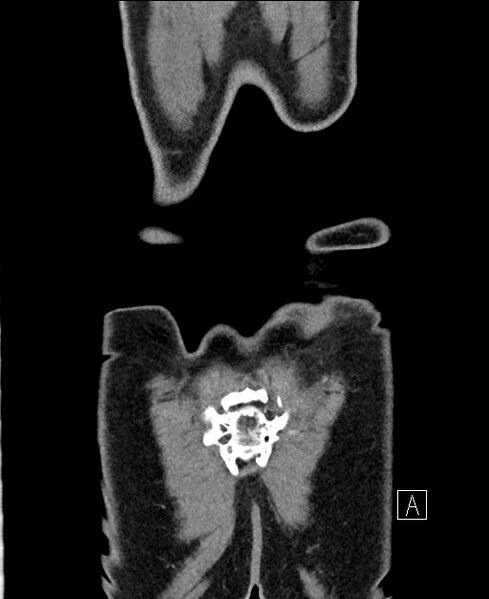 File:Closed loop small bowel obstruction - internal hernia (Radiopaedia 57806-64778 A 121).jpg