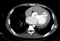 Coarctation of aorta with aortic valve stenosis (Radiopaedia 70463-80574 A 130).jpg