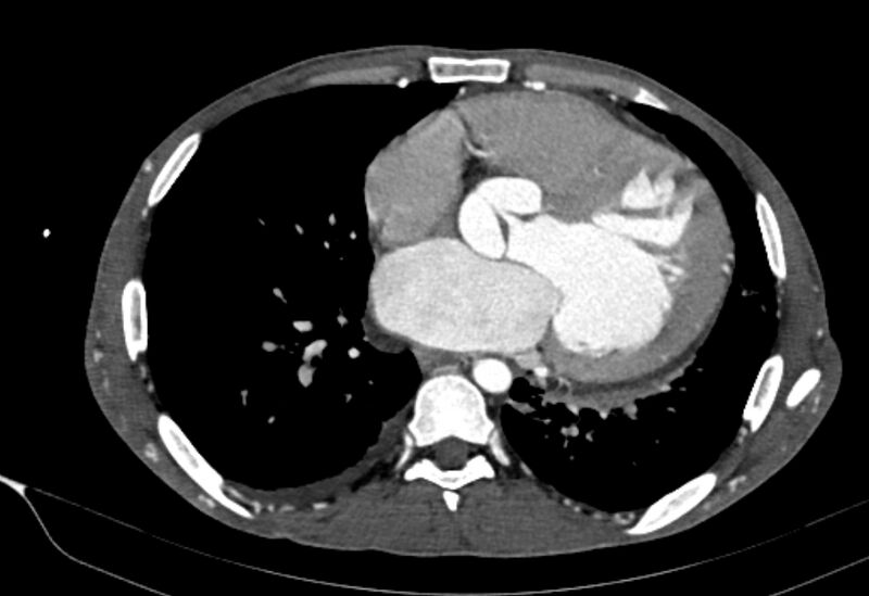 File:Coarctation of aorta with aortic valve stenosis (Radiopaedia 70463-80574 A 130).jpg