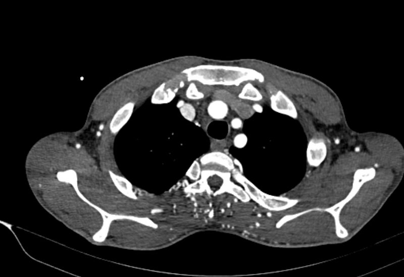 File:Coarctation of aorta with aortic valve stenosis (Radiopaedia 70463-80574 A 7).jpg