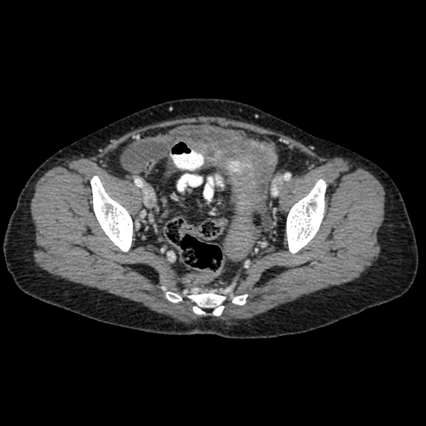 File:Cocoon abdomen with possible tubo-ovarian abscess (Radiopaedia 46235-50636 A 38).png