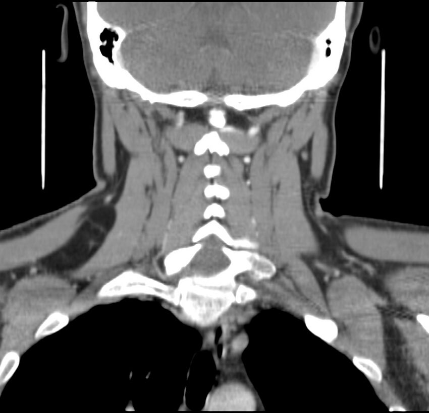 Colloid cyst of thyroid (Radiopaedia 22897-22923 Coronal C+ delayed 43).jpg