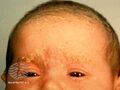 Cradle cap (DermNet NZ dermatitis-cradlecap4).jpg