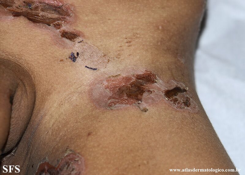 File:Impetigo (Dermatology Atlas 108).jpg