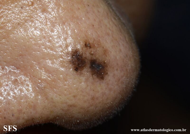 File:Melanoma (Dermatology Atlas 131).jpg