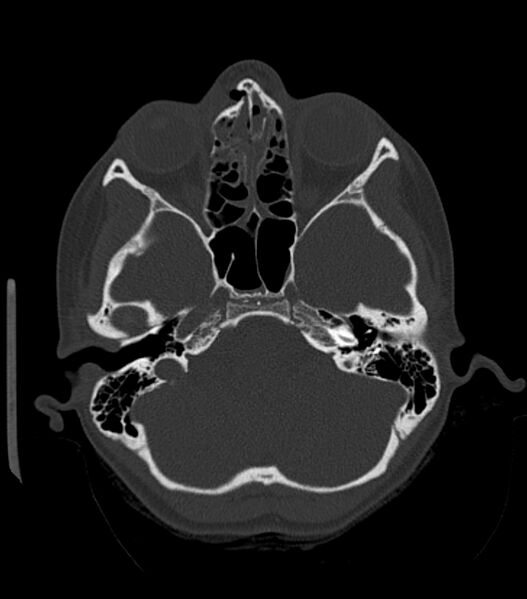 File:Nasoorbitoethmoid fracture (Radiopaedia 90044-107205 Axial bone window 78).jpg