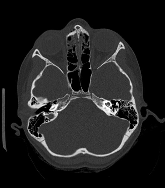 File:Nasoorbitoethmoid fracture (Radiopaedia 90044-107205 Axial bone window 80).jpg