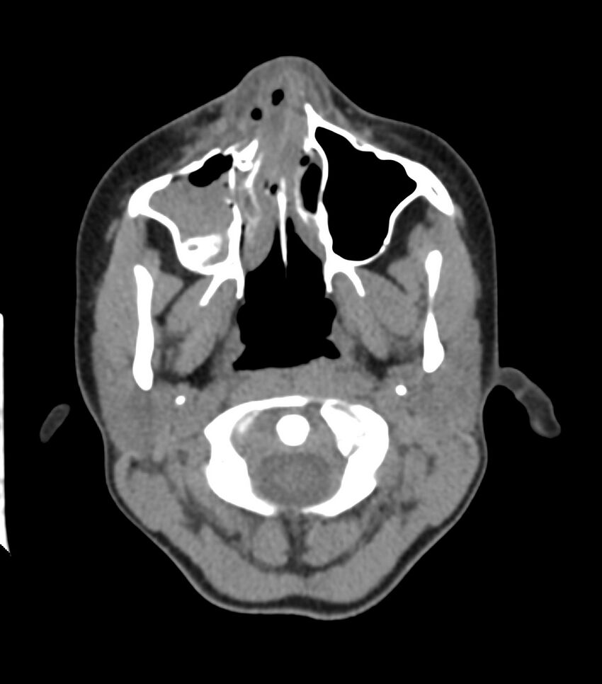 Nasoorbitoethmoid fracture (Radiopaedia 90044-107205 Axial non-contrast 117).jpg
