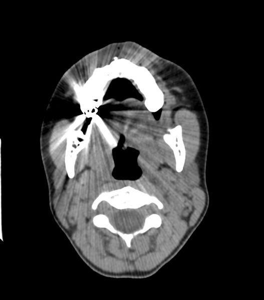 File:Nasoorbitoethmoid fracture (Radiopaedia 90044-107205 Axial non-contrast 86).jpg