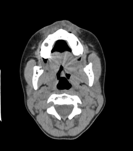 File:Nasoorbitoethmoid fracture (Radiopaedia 90044-107205 Axial non-contrast 89).jpg