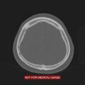 Nasopharyngeal carcinoma recurrence - skull base destruction (Radiopaedia 29107-29490 Axial bone window 21).jpg