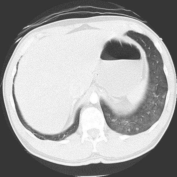 File:Near drowning pulmonary edema (Radiopaedia 16868-16591 Axial lung window 50).jpg