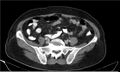 Necrotizing pancreatitis (Radiopaedia 20595-20495 A 32).jpg