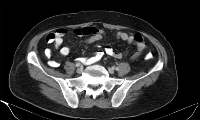 File:Necrotizing pancreatitis (Radiopaedia 20595-20495 A 32).jpg