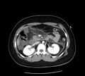 Necrotizing pancreatitis (Radiopaedia 23001-23031 A 33).jpg