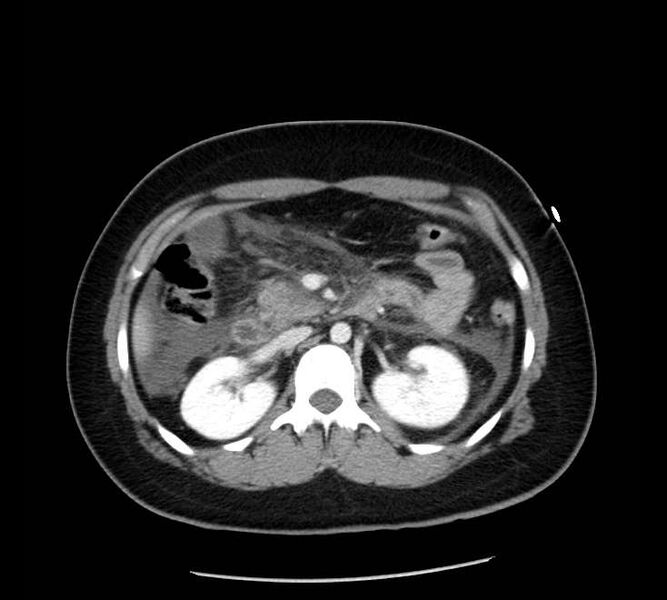 File:Necrotizing pancreatitis (Radiopaedia 23001-23031 A 33).jpg