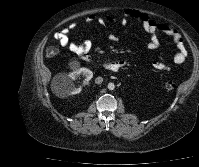Nephroptosis with inguinal hernia containing perirenal fat (Radiopaedia 56632-63391 C 157).jpg