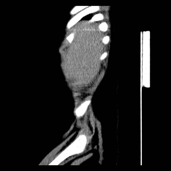 File:Neuroblastoma with skull metastases (Radiopaedia 30326-30960 B 3).jpg