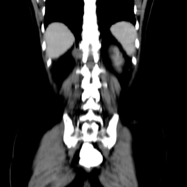File:Neurofibroma - spine (Radiopaedia 27891-28125 B 25).jpg