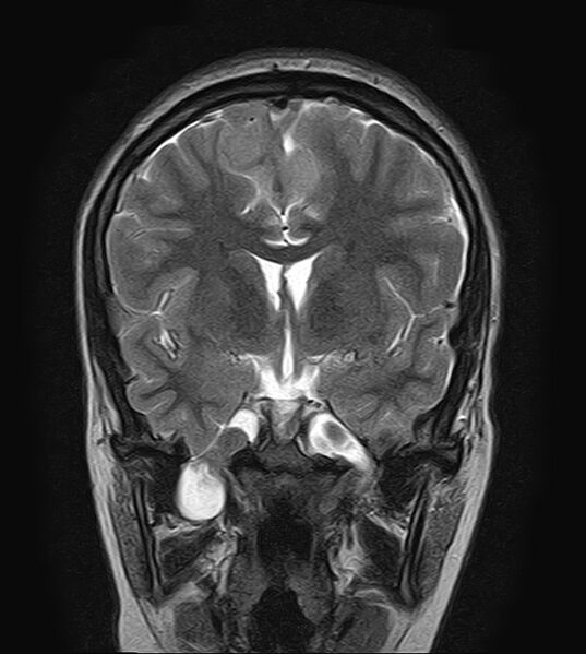File:Neurofibromatosis type 2 (Radiopaedia 66211-75401 Coronal T2 10).jpg