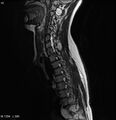 Neurofibromatosis type 2 - cranial and spinal involvement (Radiopaedia 5351-7112 Sagittal T2 7).jpg