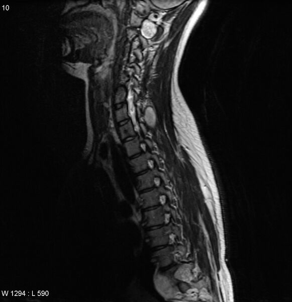 File:Neurofibromatosis type 2 - cranial and spinal involvement (Radiopaedia 5351-7112 Sagittal T2 7).jpg