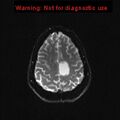 Neuroglial cyst (Radiopaedia 10713-11184 Axial DWI 5).jpg