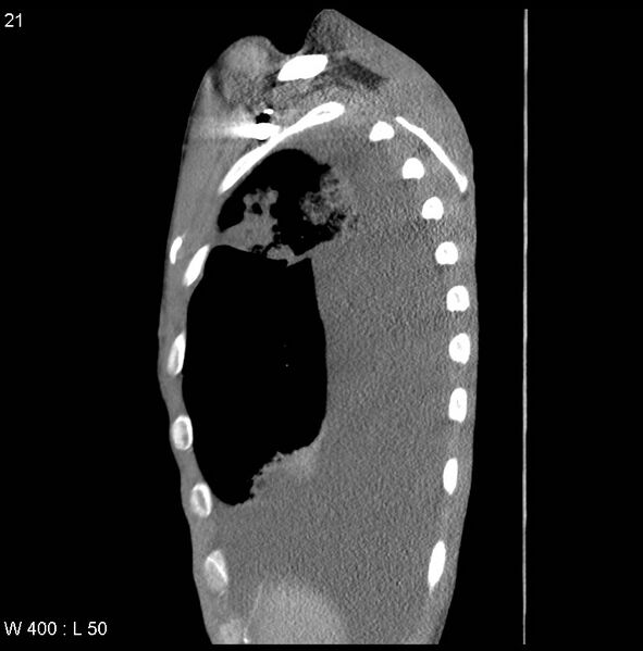 File:Non-Hodgkin lymphoma involving lung (Radiopaedia 29094-29470 D 12).jpg