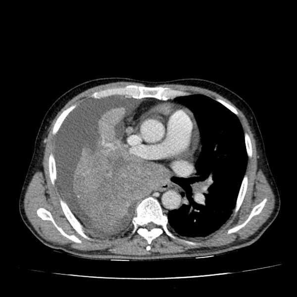 File:Non small-cell lung cancer (Radiopaedia 24467-24769 C+ delayed 30).jpg