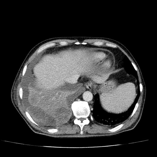 File:Non small-cell lung cancer (Radiopaedia 24467-24769 C+ delayed 51).jpg