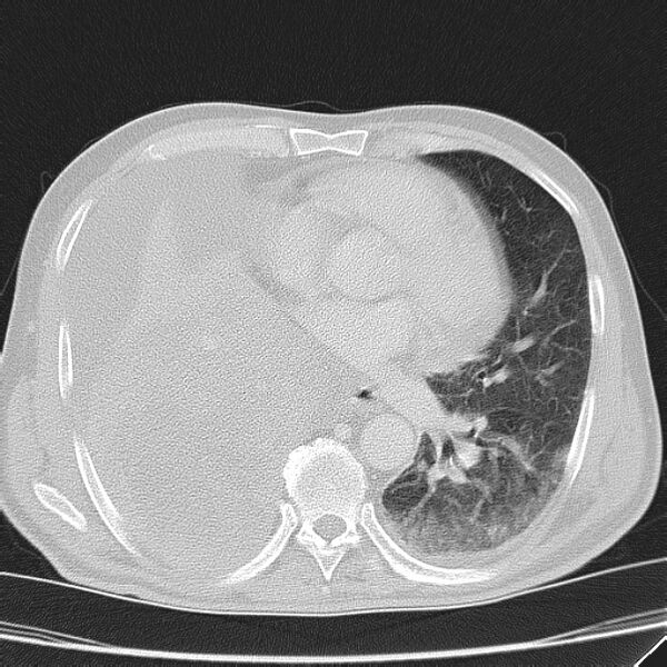 File:Non small-cell lung cancer (Radiopaedia 24467-24769 lung window 30).jpg