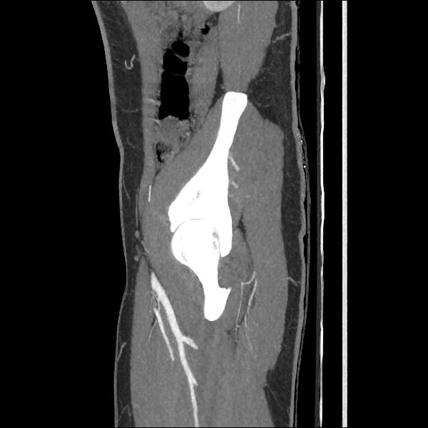 File:Normal CT angiogram of pelvis (Radiopaedia 45390-49430 C 19).jpg
