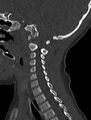 Normal CT cervical spine - pediatric (Radiopaedia 52549-58462 Sagittal bone window 69).jpg