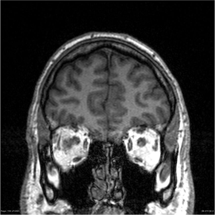 Normal brain MRI (non-focal epilepsy protocol) (Radiopaedia 38571-40700 Coronal T1 86).jpg