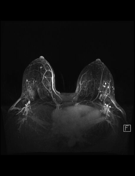 File:Normal breast MRI - dense breasts (Radiopaedia 80454-93850 Axial MIPS 2).jpg