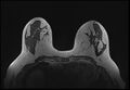 Normal breast MRI - dense breasts (Radiopaedia 80454-93850 Axial T1 105).jpg