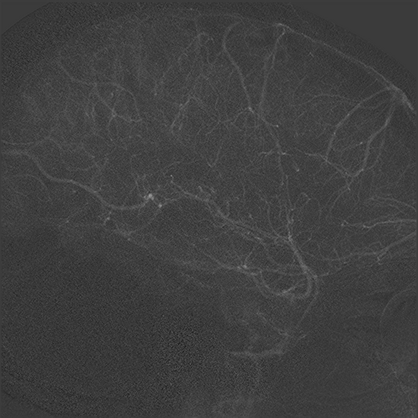 File:Normal cerebral angiogram (four vessel DSA) (Radiopaedia 41708-44649 F 15).png