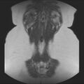 Normal liver MRI with Gadolinium (Radiopaedia 58913-66163 Coronal T2 37).jpg