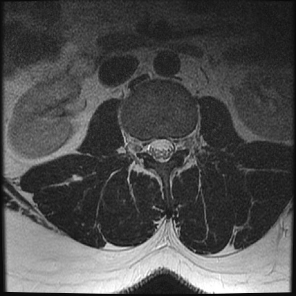 File:Normal lumbar spine MRI (Radiopaedia 43051-46311 Axial T2 6).jpg