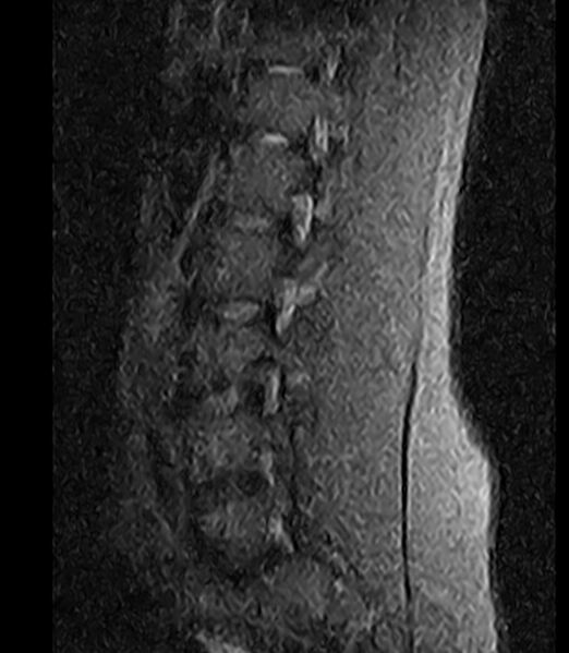 File:Normal lumbar spine MRI - low-field MRI scanner (Radiopaedia 40976-43699 Sagittal STIR 9).jpg