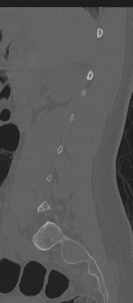 File:Normal lumbosacral CT (Radiopaedia 37923-39867 Sagittal bone window 70).png