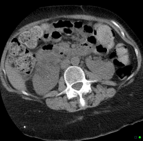 File:Obstructed infected horseshoe kidney (Radiopaedia 18116-17898 non-contrast 11).jpg
