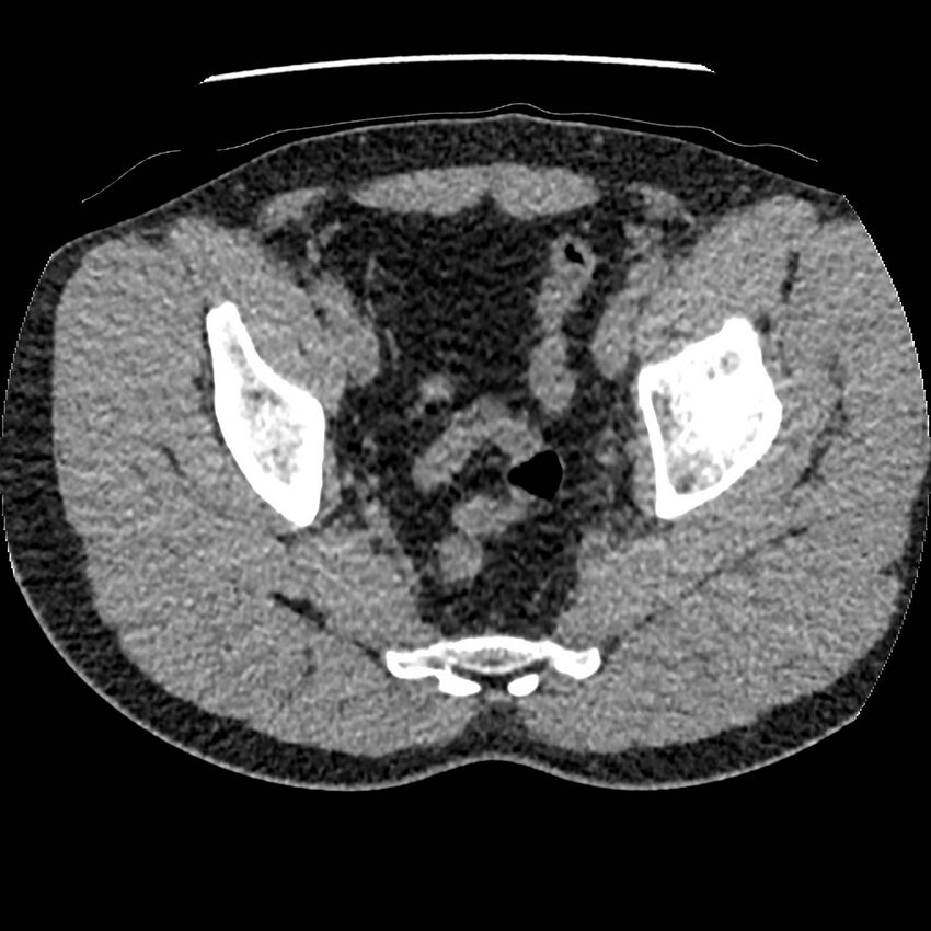 Obstructing ureteric calculus and ureteric anatomy (Radiopaedia 62730-71042 Axial non-contrast 146).jpg