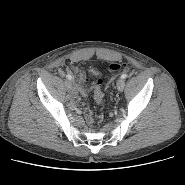 File:Obstructive bladder transitional cell carcinoma (Radiopaedia 9825-10410 A 27).jpg