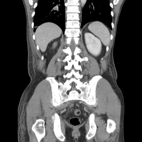 File:Obstructive bladder transitional cell carcinoma (Radiopaedia 9825-10410 B 22).jpg