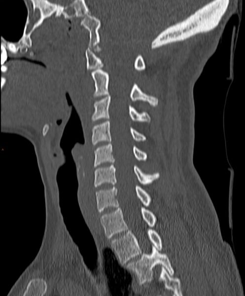 File:Occipital condyle fracture (Radiopaedia 61165-69056 Sagittal bone window 14).jpg
