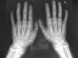 ( Marshall-Stickler overlap) Anteroposterior hand radiograph showed, short-stubby hand with large carpal bones associated with pseudoepiphyses of a joint.